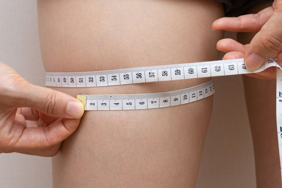 Lipedema: quando não é só gordura localizada