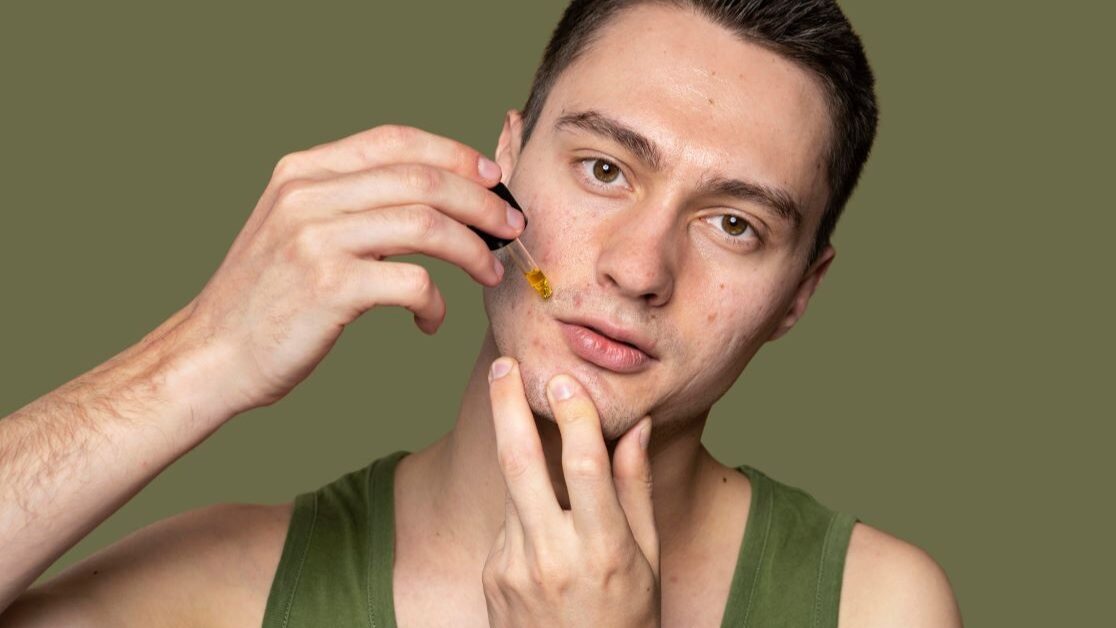 Acne adulta